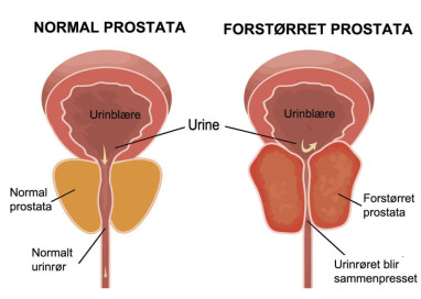 image: Tilbakevendende urinveisinfeksjoner hos menn image: Tilbakevendende urinveisinfeksjoner hos menn
